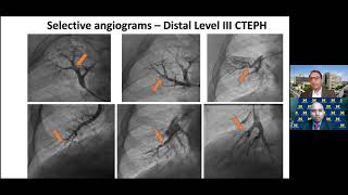 How to perform a Balloon Pulmonary Angioplasty BPA [upl. by Namus]