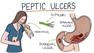 Understanding Stomach and Duodenal Ulcers [upl. by Kennard]