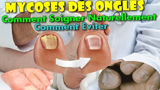 Mycoses des Ongles  Comment Soigner Naturellement amp Comment léviter [upl. by Ralyat]