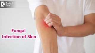 Skin Mycosis Symptoms Causes amp Treatment  Fungal Infection  Dr Rajdeep Mysore  Doctors Circle [upl. by Emie]