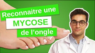 Savoir RECONNAÎTRE une MYCOSE de longle  Onychomycose 13 [upl. by Corbett]