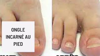 Ongle incarné au pied [upl. by Keith]